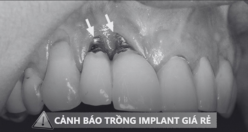 Chuyên gia Smilux cảnh báo nguy hại khôn lường khi trồng răng giá rẻ