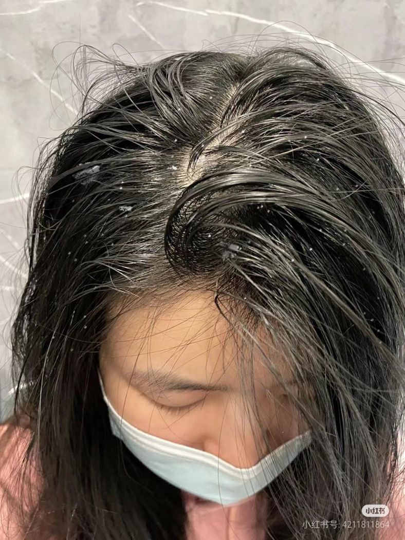 Đỗ Tùng và Hương Nhu Trắng - bộ đôi dược liệu hỗ trợ làm sạch gàu