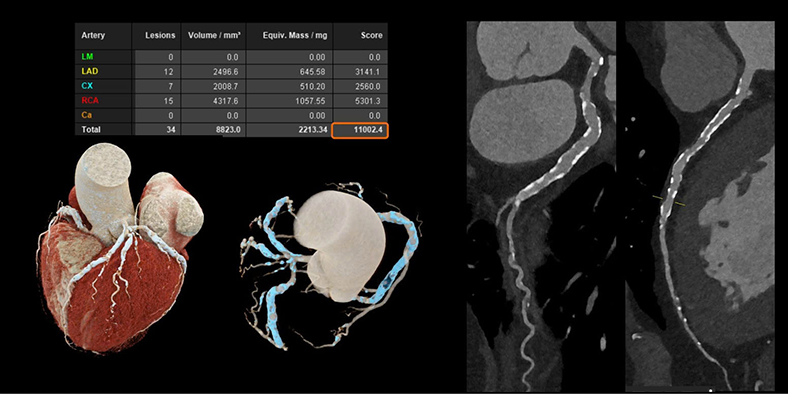 Công nghệ cắt lớp vi tính lượng tử: Mở ra cơ hội phát hiện bệnh sớm