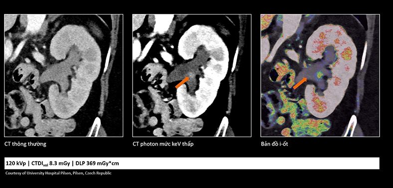 Công nghệ cắt lớp vi tính lượng tử: Mở ra cơ hội phát hiện bệnh sớm
