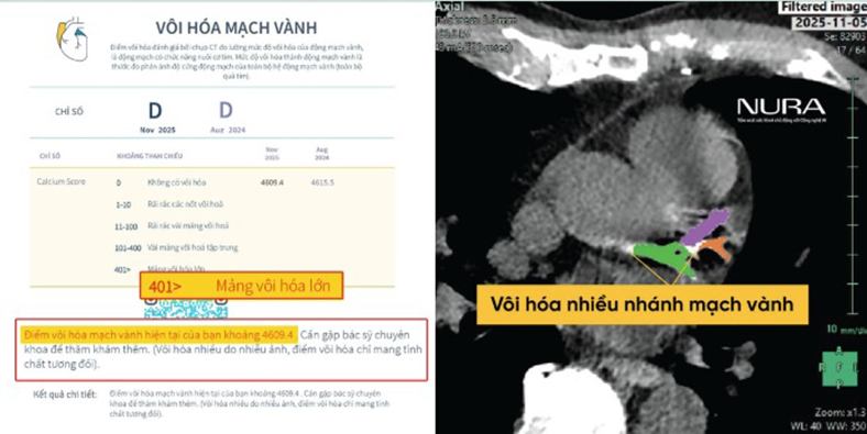 AI giúp bác sĩ nhìn thấy nguy cơ tim mạch trước 10 năm