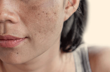 Vì sao da người Việt dễ sạm nám?