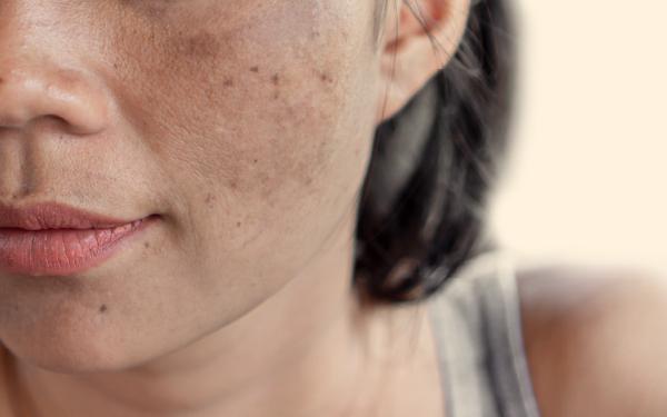 Vì sao da người Việt dễ sạm nám?